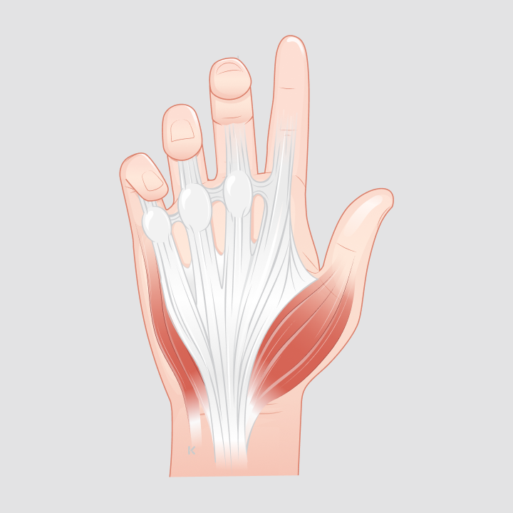 Illustration einer Handinnenfläche mit knotigen und strangartigen Bindegewebsveränderungen bei Morbus Dupuytren