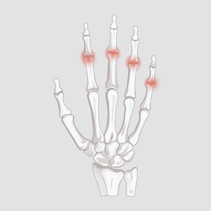 Arthrose der Fingermittelgelenke (Bouchard-Arthrose)