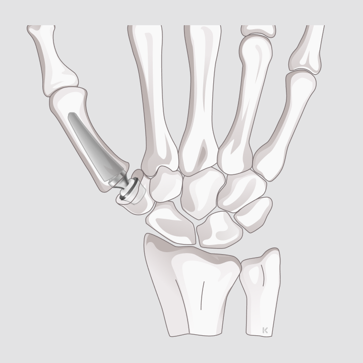 Illustration einer Hand mit implantierter Prothese im Daumensattelgelenk