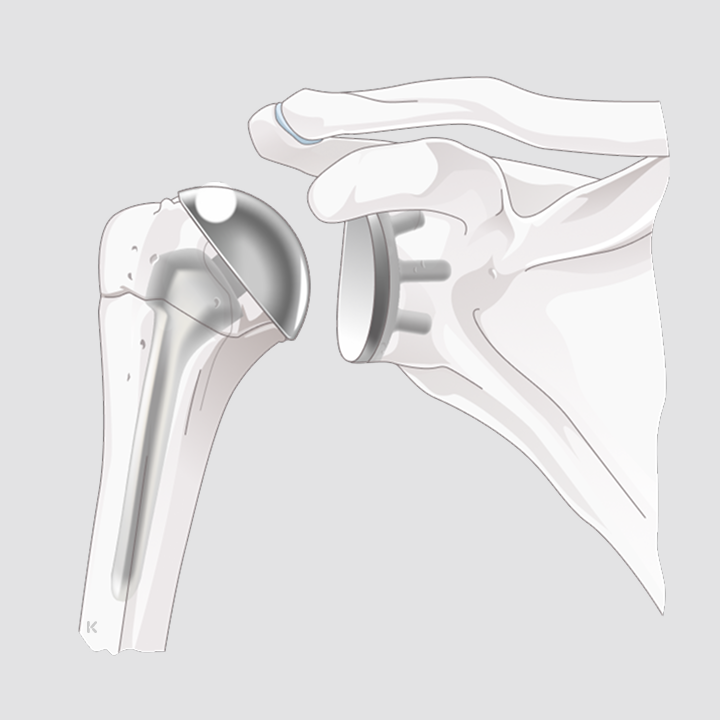 Illustration: Schulter mit eingesetzter anatomischer Schulterprothese, Seitenansicht