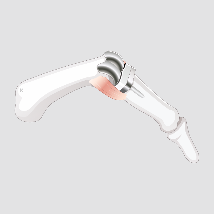 Fingergelenksprothese - Orthopädie Rosenberg
