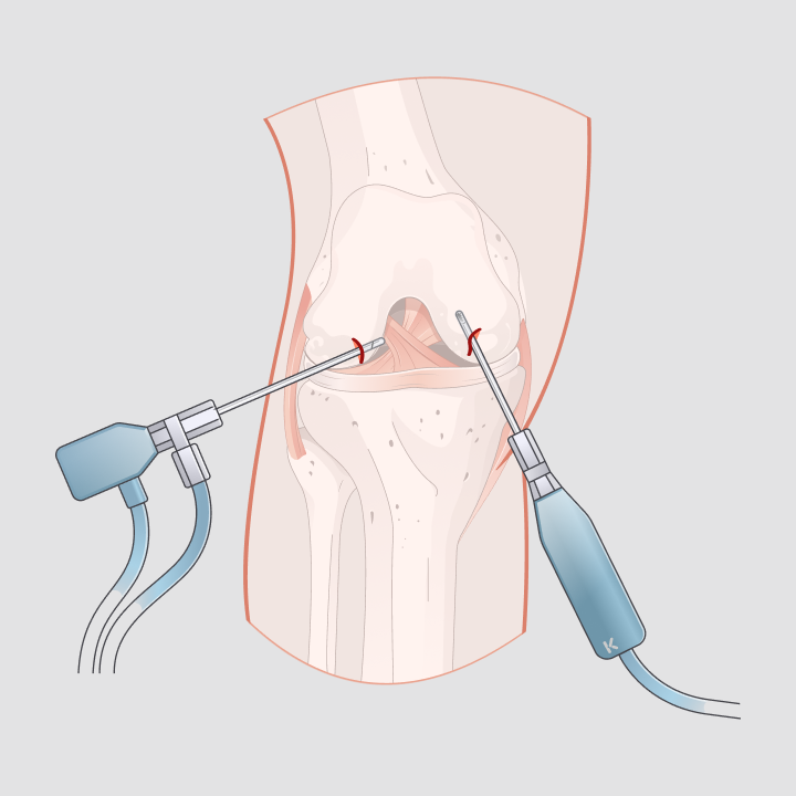 Illustration einer minimalinvasiven Kniespiegelung mit zwei eingeführten Arthroskopie-Instrumenten im Gelenk