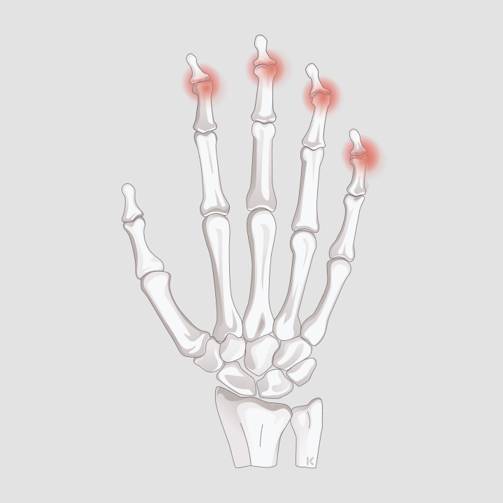 Handskelett mit rot markierten arthrotischen Veränderungen an den Fingerendgelenken