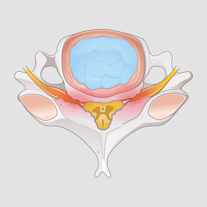 Spinalkanalstenose HWS - Orthopädie Rosenberg