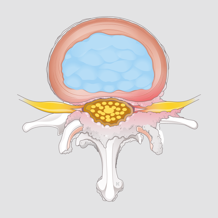 Spinalkanalstenose LWS - Orthopädie Rosenberg