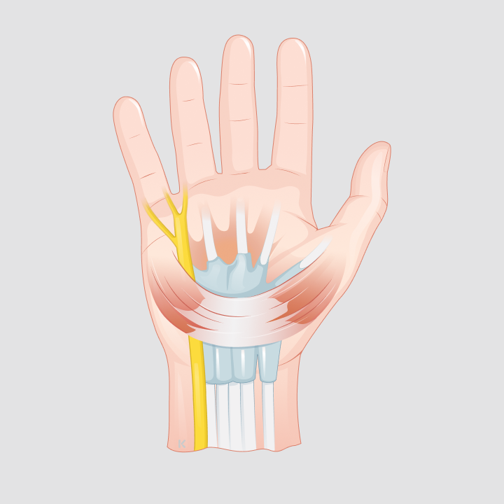 Illustration einer Handinnenfläche mit farblich hervorgehobenem Ellennerv im Bereich der Guyon-Loge am Handgelenk