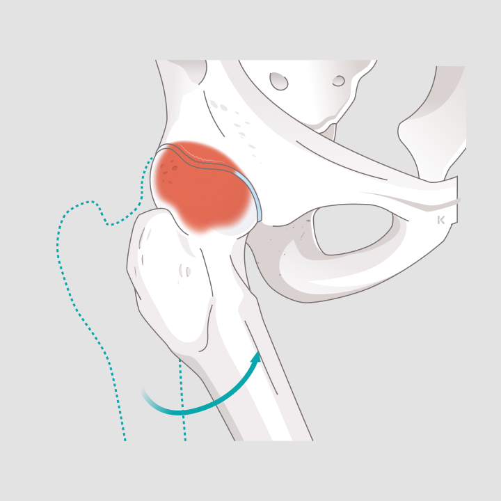 Anatomische Darstellung eines Hüftgelenks mit rot markierter Einklemmung zwischen Oberschenkelkopf und Hüftpfanne