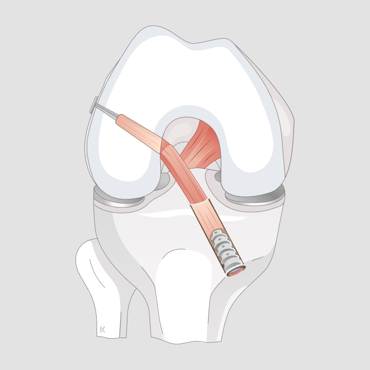 Illustration einer Kreuzband-Rekonstruktion mit eingesetztem Sehnentransplantat im Kniegelenk