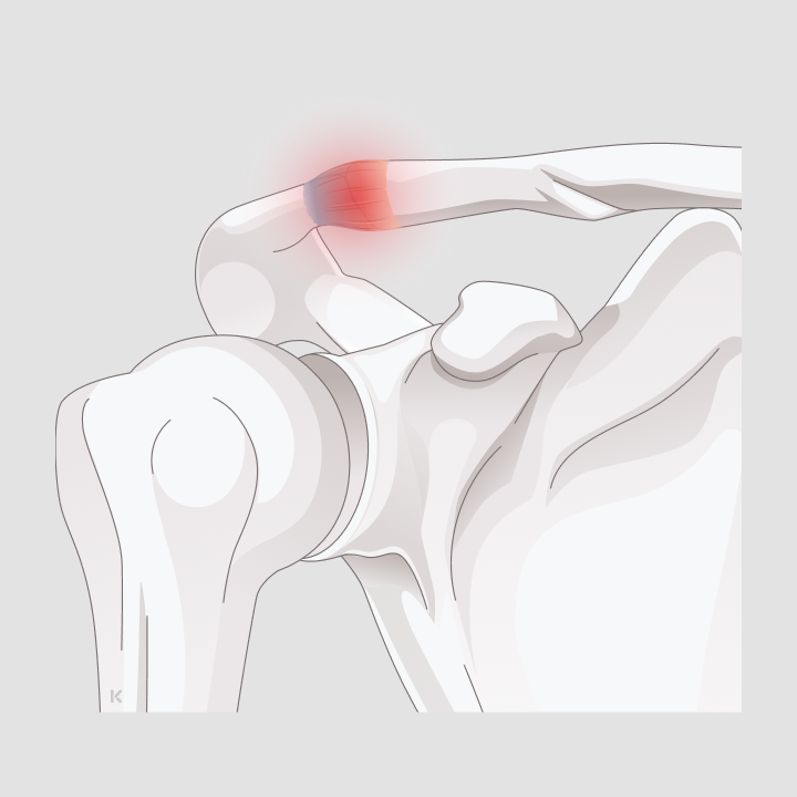 Illustration: Schulter von oben mit rot markierter Instabilität am Schultereckgelenk zwischen Schlüsselbein und Schulterblatt