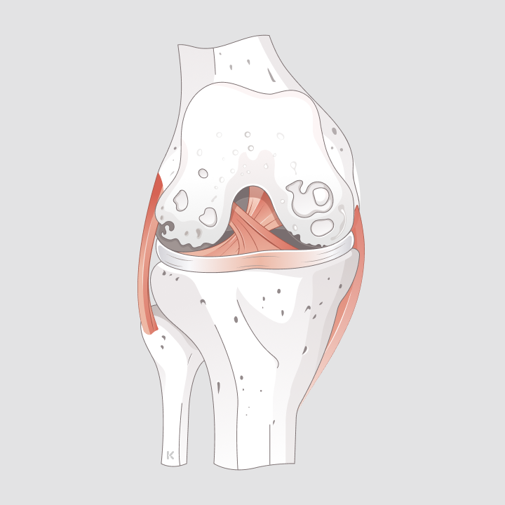 Illustration eines Kniegelenks mit arthrotischen Veränderungen und Knorpelabnutzung
