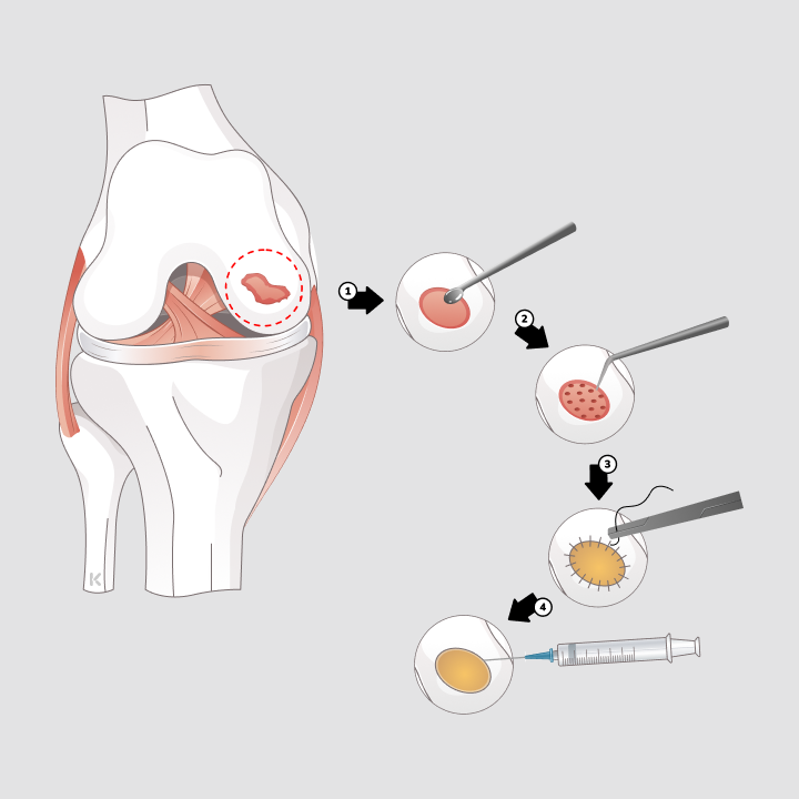 Schematische Darstellung der Knorpelregeneration: Entnahme, Aufbereitung und Einsetzen von Knorpelzellen