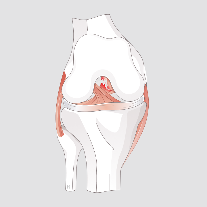 Anatomische Illustration des Kniegelenks mit Riss des hinteren Kreuzbands
