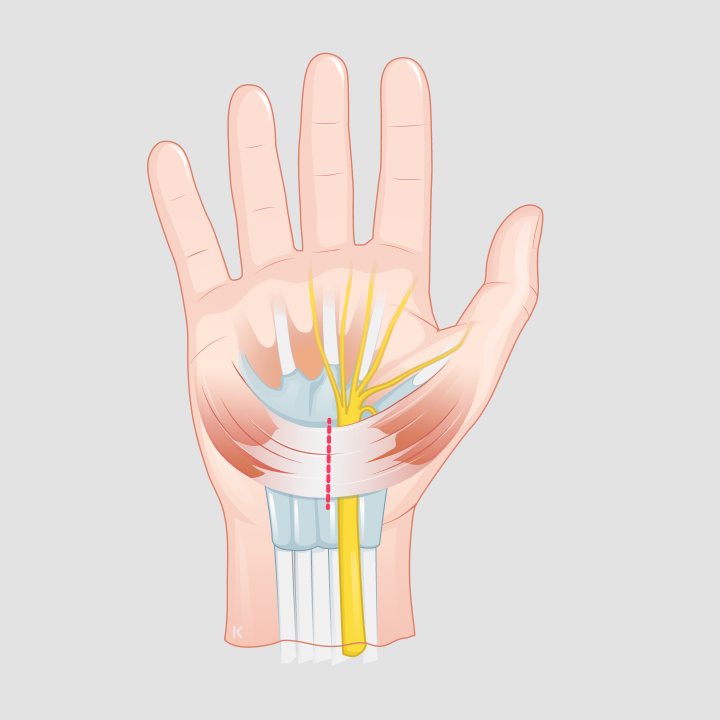 Illustration einer Handfläche mit farblich hervorgehobenem Medianusnerv und Sehnen im Karpaltunnel