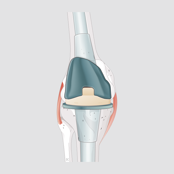 Anatomische Darstellung eines Kniegelenks mit gelockerter Prothese und sichtbarer Knochenabnutzung im Implantatbereich